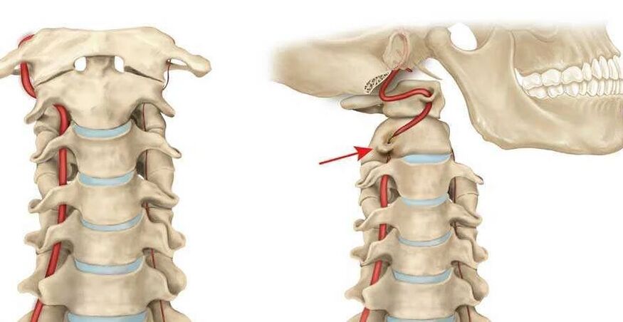 syndróm vertebrálnej artérie