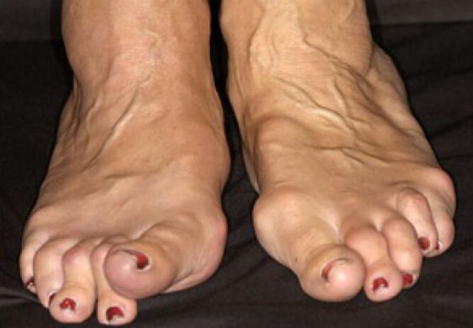 Deformácia