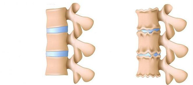 Čo je osteochondróza