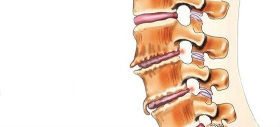 Čo je spondylóza