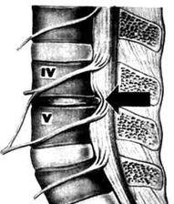 X -ray Obrázok bedrového oddelenia osteochondrózy