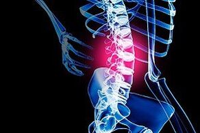 osteochondróza bedrovej chrbtice