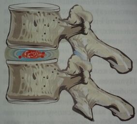 Prvá fáza osteochondrózy