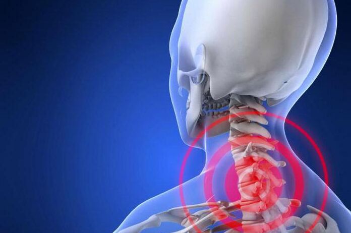 Streľba bolesti v krku je skorým príznakom cervikálnej osteochondrózy