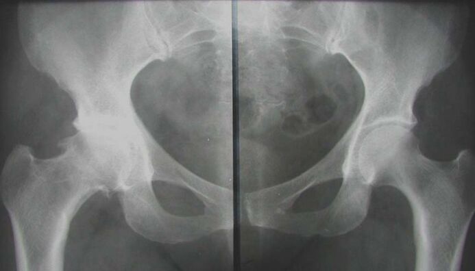 röntgen postihnutého bedrového kĺbu s artrózou